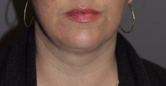 35-44 year old woman treated with Kybella after 3147388