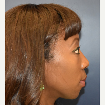 35-44 year old woman treated with Rhinoplasty before 3288993