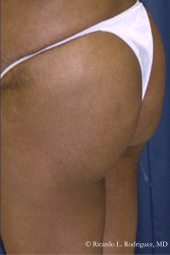 Brazilian Butt Lift after 101295