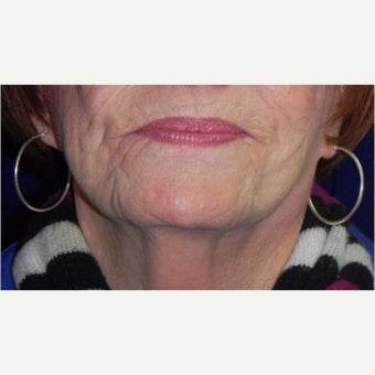 65-74 year old woman treated with ThermiSmooth before 2356128