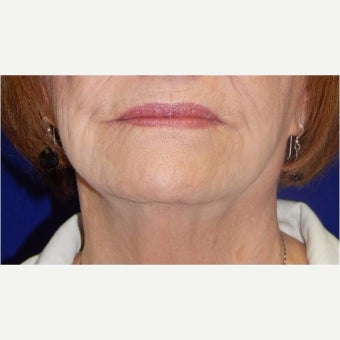 65-74 year old woman treated with ThermiSmooth after 2356128