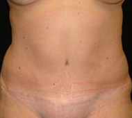35-44 year old woman treated with Tummy Tuck after 2285556
