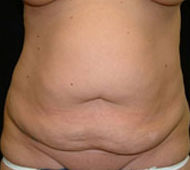 35-44 year old woman treated with Tummy Tuck before 2285556