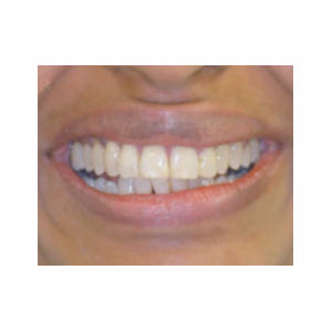 Gaps between teeth treated with Clear Braces after 3696122