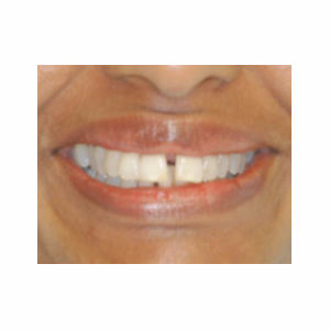 Gaps between teeth treated with Clear Braces before 3696122