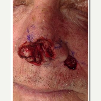 65-74 year old man treated with Facial Reconstructive Surgery before 3288330