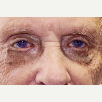 87 year old woman treated with Ectropion Eyelid Surgery before 3151879