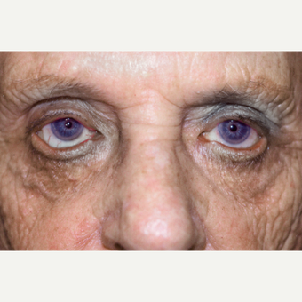 87 year old woman treated with Ectropion Eyelid Surgery after 3151879