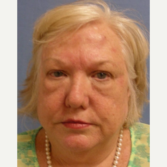 55-64 year old woman treated with Eyelid Surgery before 3644700