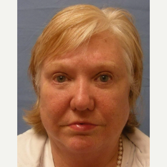 55-64 year old woman treated with Eyelid Surgery after 3644700