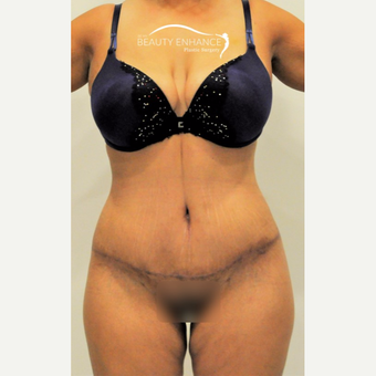 Extended Tummy Tuck & BBL after 3823419