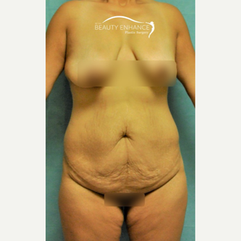 Extended Tummy Tuck & BBL before 3823419
