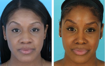 African American rhinoplasty before 1026931