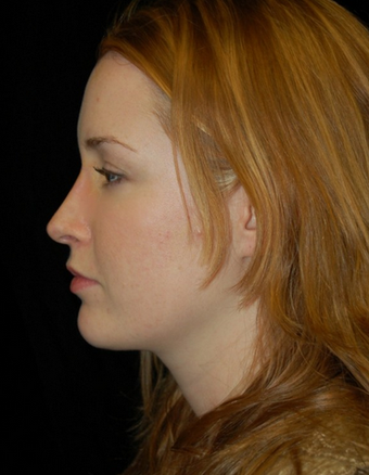 Nose Surgery - Rhinoplasty after 1253149