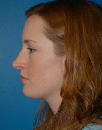Nose Surgery - Rhinoplasty before 1253149