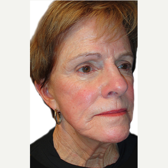 60 year old woman treated with Neck Lift before 3409126