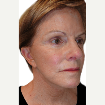 60 year old woman treated with Neck Lift after 3409126
