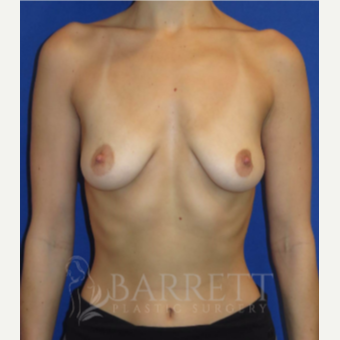 25-34 year old woman treated with Breast Augmentation before 3611972