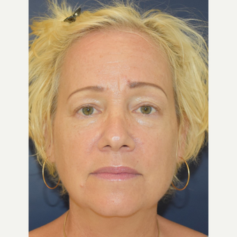 55-64 year old woman treated with MACS Facelift before 3504007