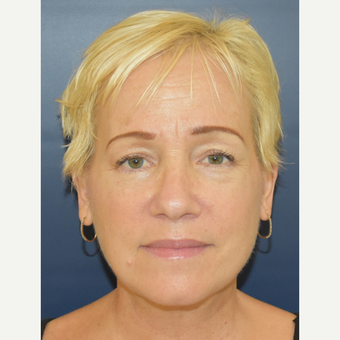 55-64 year old woman treated with MACS Facelift after 3504007