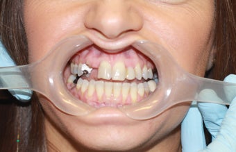 35 year old female treated with All-on-4 DentalImplant Procedure before 1053436