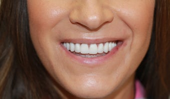 35 year old female treated with All-on-4 DentalImplant Procedure after 1053436