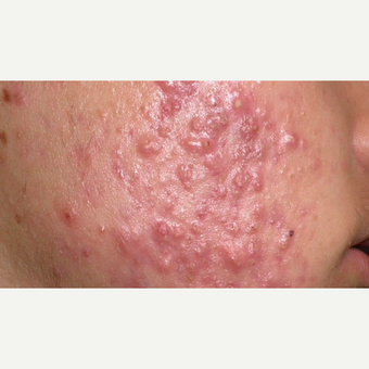minimise acne scars before 3685492