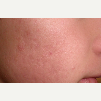 minimise acne scars after 3685492