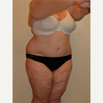 45-54 year old woman treated with Tummy Tuck after 3658170