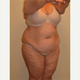 45-54 year old woman treated with Tummy Tuck before 3658170