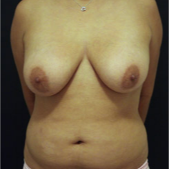 25-34 year old woman treated with Breast Lift before 3742348