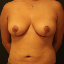 25-34 year old woman treated with Breast Lift after 3742348