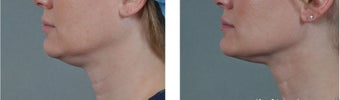 ThermiSculpt patient before 1110564