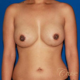 32 year old mom of two had breast augmentation to improve fullness after 3522578