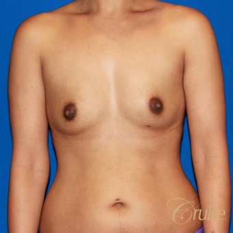 32 year old mom of two had breast augmentation to improve fullness before 3522578
