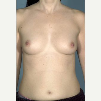 35-44 year old woman treated with Breast Implants before 3732004