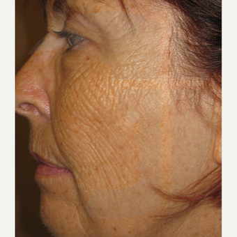 65-74 year old woman treated with Laser Treatment before 2759318