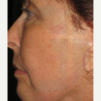 65-74 year old woman treated with Laser Treatment after 2759318