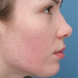 Acne Scars Treatment after 1677185