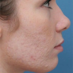 Acne Scars Treatment before 1677185