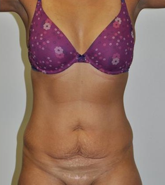 25-34 year old woman treated with Tummy Tuck before 1860280