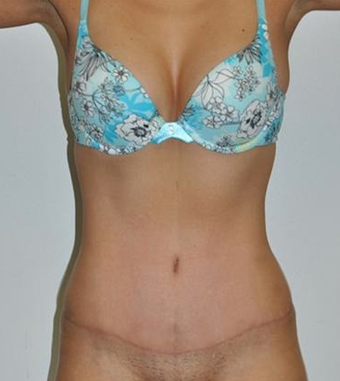 25-34 year old woman treated with Tummy Tuck after 1860280