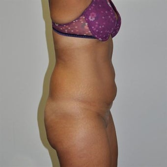 25-34 year old woman treated with Tummy Tuck 1860280
