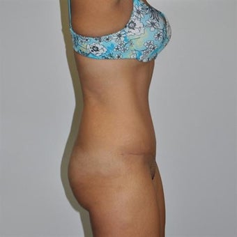 25-34 year old woman treated with Tummy Tuck 1860280