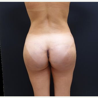 35-44 year old woman treated with 548cc Butt Implants after 3235638