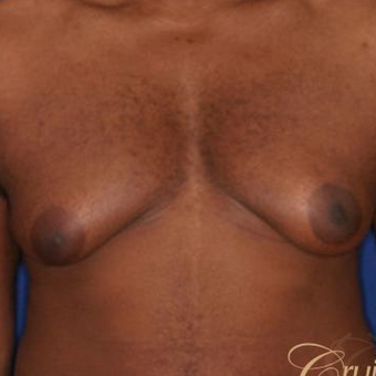 18-24 year old man treated with Male Breast Reduction before 3502215