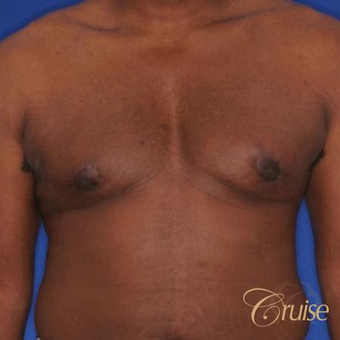 18-24 year old man treated with Male Breast Reduction after 3502215