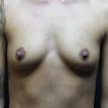 25-34 year old woman treated with Breast Augmentation before 3665305