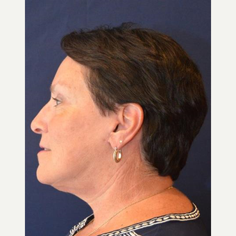 55-64 year old woman treated with Facelift after 3339834