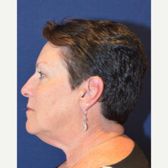 55-64 year old woman treated with Facelift before 3339834